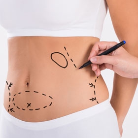 ABDOMINOPLASTIA