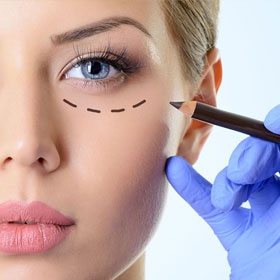 BLEFAROPLASTIA
