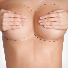 MAMOPLASTIA REDUTORA
