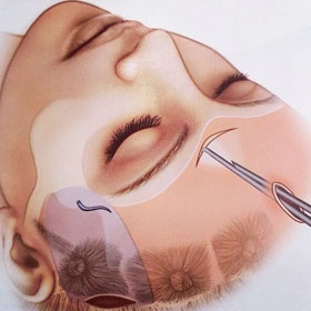 PLÁSTICA VÍDEOENDOSCÓPICA